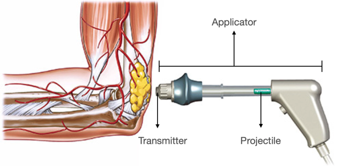 Blog_Shockwavetherapy2